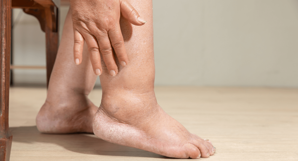 Таблетки від набряку ніг: які вибрати та як повернути легкість кроків